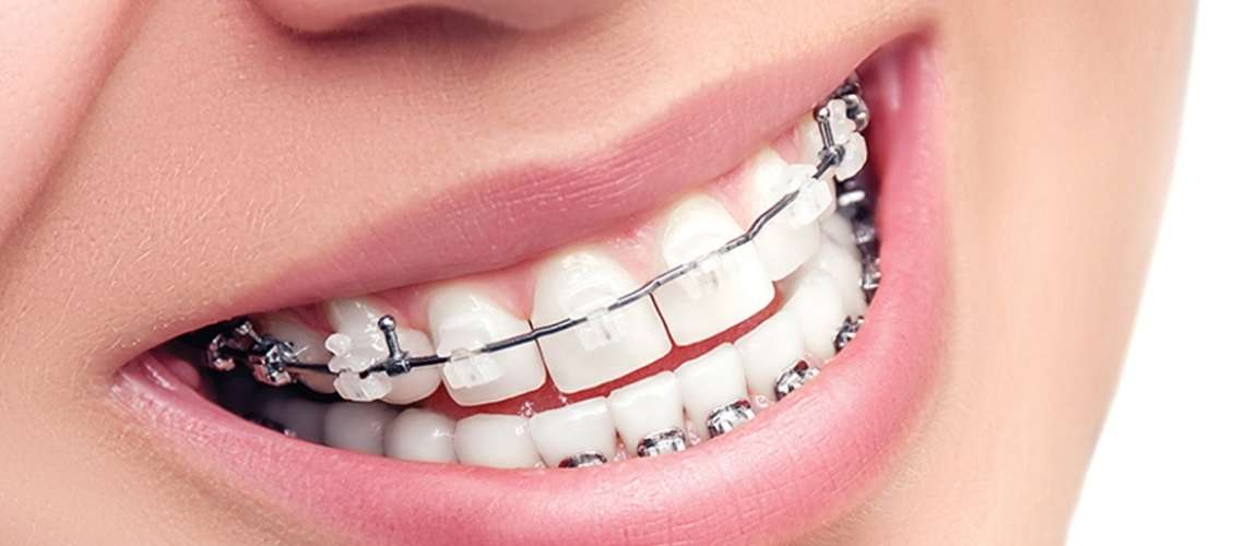Ortodonti Tedavi Nedir?