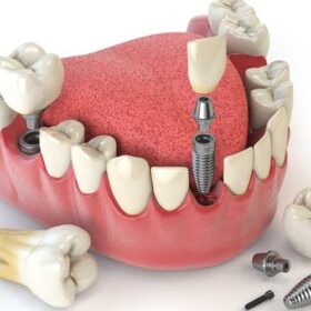Dental Implant in İzmir, Turkey