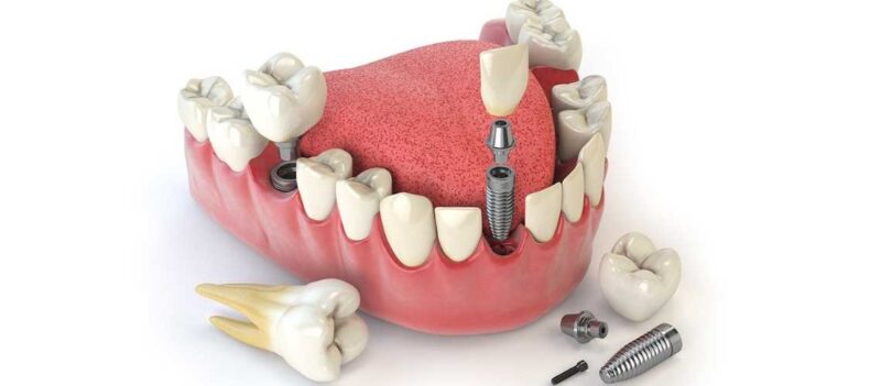 Dental Implant in İzmir, Turkey